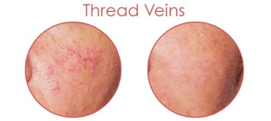 How do facial thread veins affect confidence?